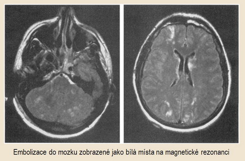 Vícečetné infarkty v MR zobrazení v důsledku opakovaných embolizací